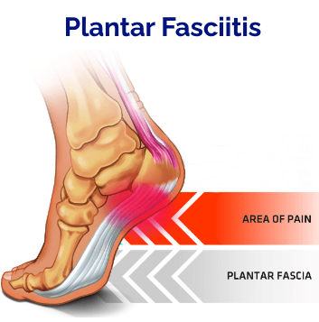 Plantar Fasciitis Heel pain Foot pain
