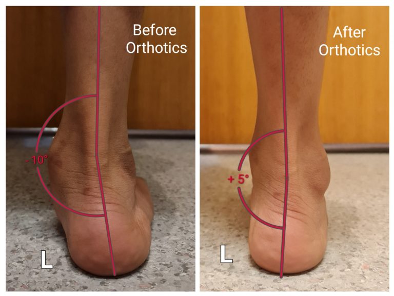 Flat Feet - Orthotic Management