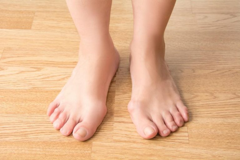 Bunions - treatment at the Podiatry and Injury Clinic