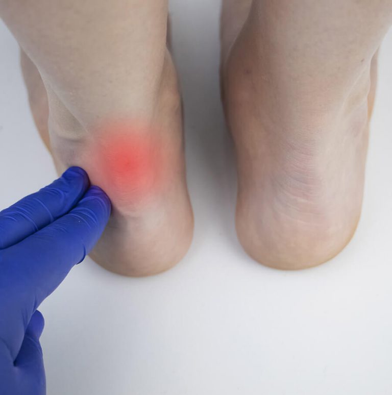 Achilles tendonitis heel pain calf pain